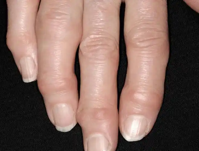 手指僵硬是为什么?_关节炎_活动_类风湿性