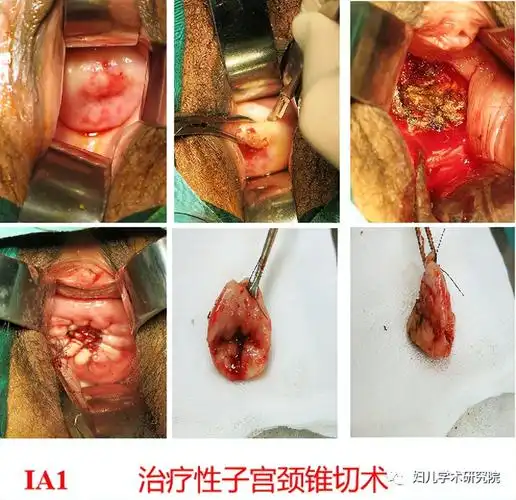 盆腔淋巴结|子宫颈癌|hsil|宫颈癌|hpv|鳞状|上皮|讲解|防治|病变