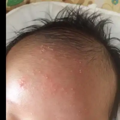 都说是热毒热的,穿盖都很薄,医生说是毛囊炎开了匹得邦,不管用