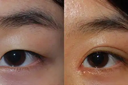 【图】眼睑下垂该怎么办 专家教你早日预防的n个妙招