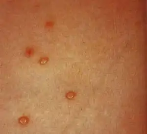 控制病情持续发展,下面一起看看介绍的女性一期梅毒症状图