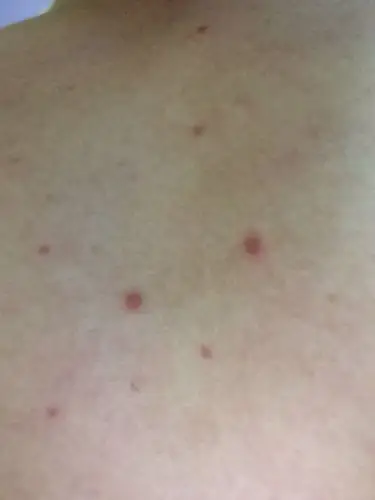 谁帮我看一下前胸的红点是什么?后背也有,谢谢啦