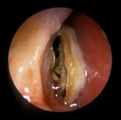 鼻窦炎症状图片 (44)