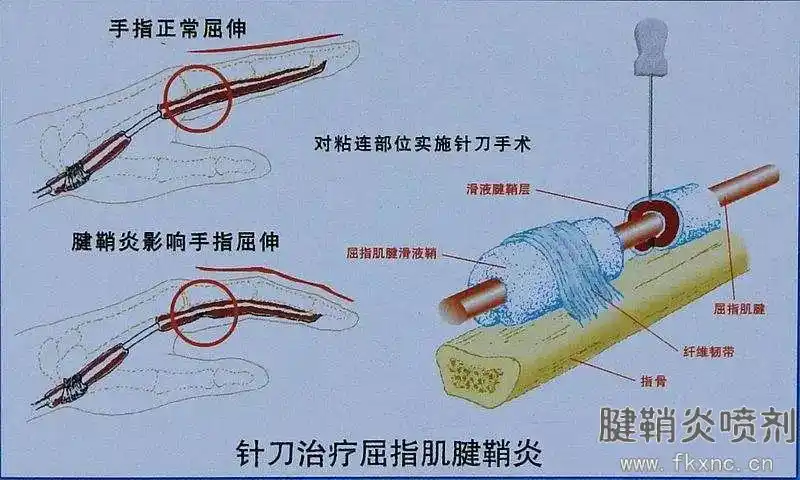 腱鞘炎怎么办 腱鞘炎医保用药