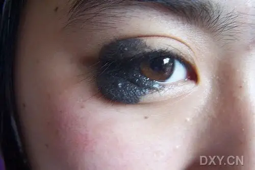 【讨论】这个眼睑分裂痣该如何处理? [病例帖]