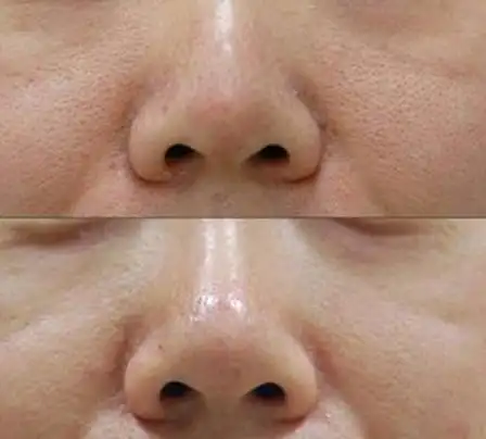 收缩毛孔的毛孔形成