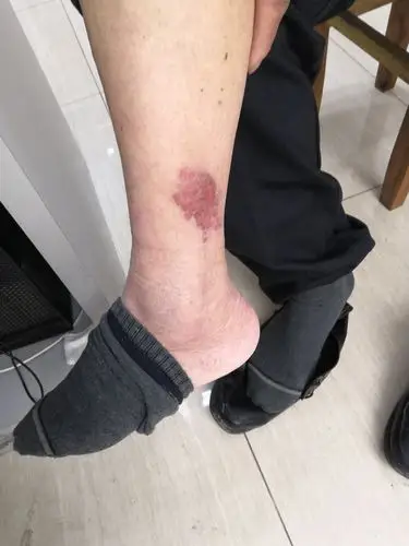 双足小腿牛皮廯病例