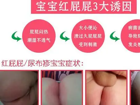 宝宝得了尿布疹,教你自制紫草油,方法简单效果好!_婴儿_皮肤_屁股