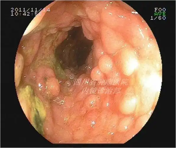 哪种肠息肉需要切除? - 好大夫在线