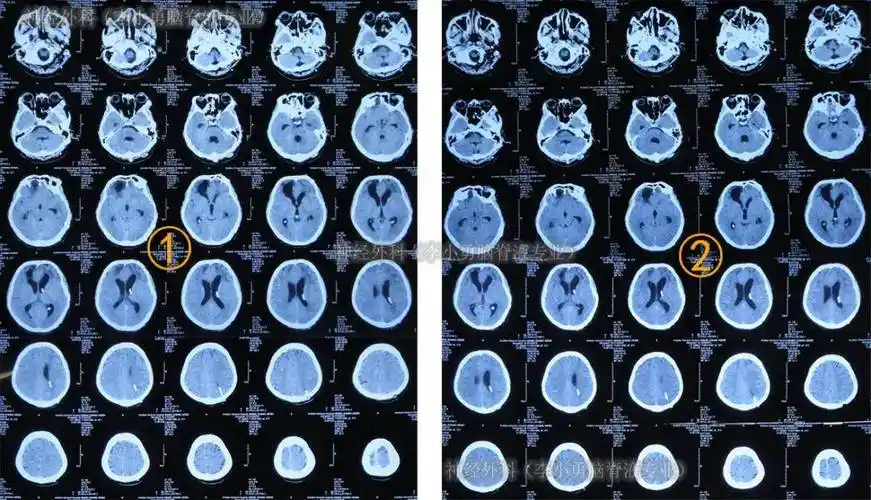 图-12:2次查头颅ct脑脊液化验各项达标后于2018年4月26日,进行了脑室