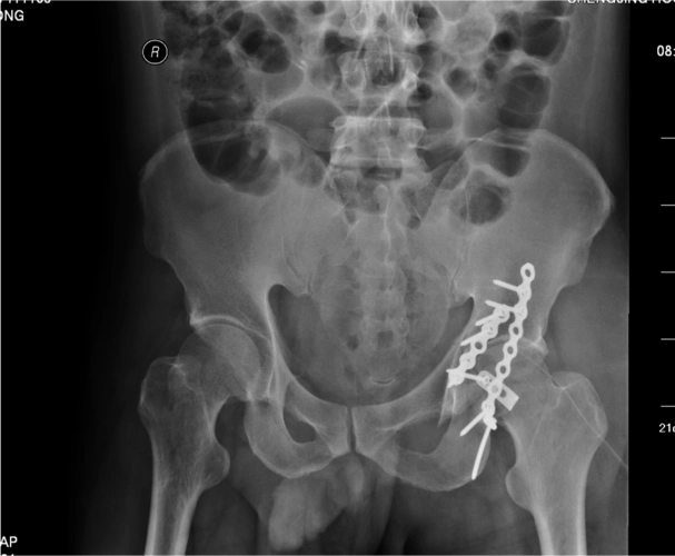 左髋臼骨折(后壁骨折)