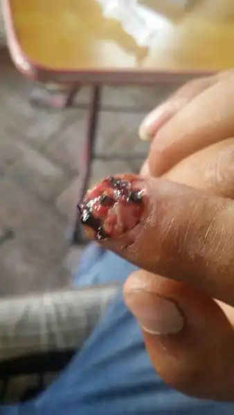 男朋友手指头被车门夹了,肉脱下来了连着一点,去医院医生说骨头没断就