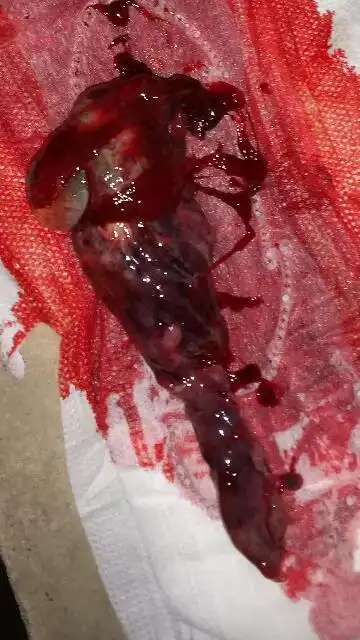 两个月的宝宝流产后是什么样的,请问我的是不是流产啊,是不是要成形了