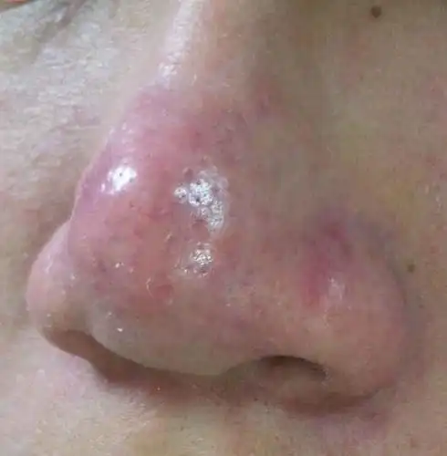 酒糟鼻都有哪些症状表现