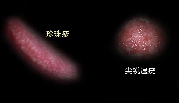 珍珠状丘疹和尖锐湿疣的区别
