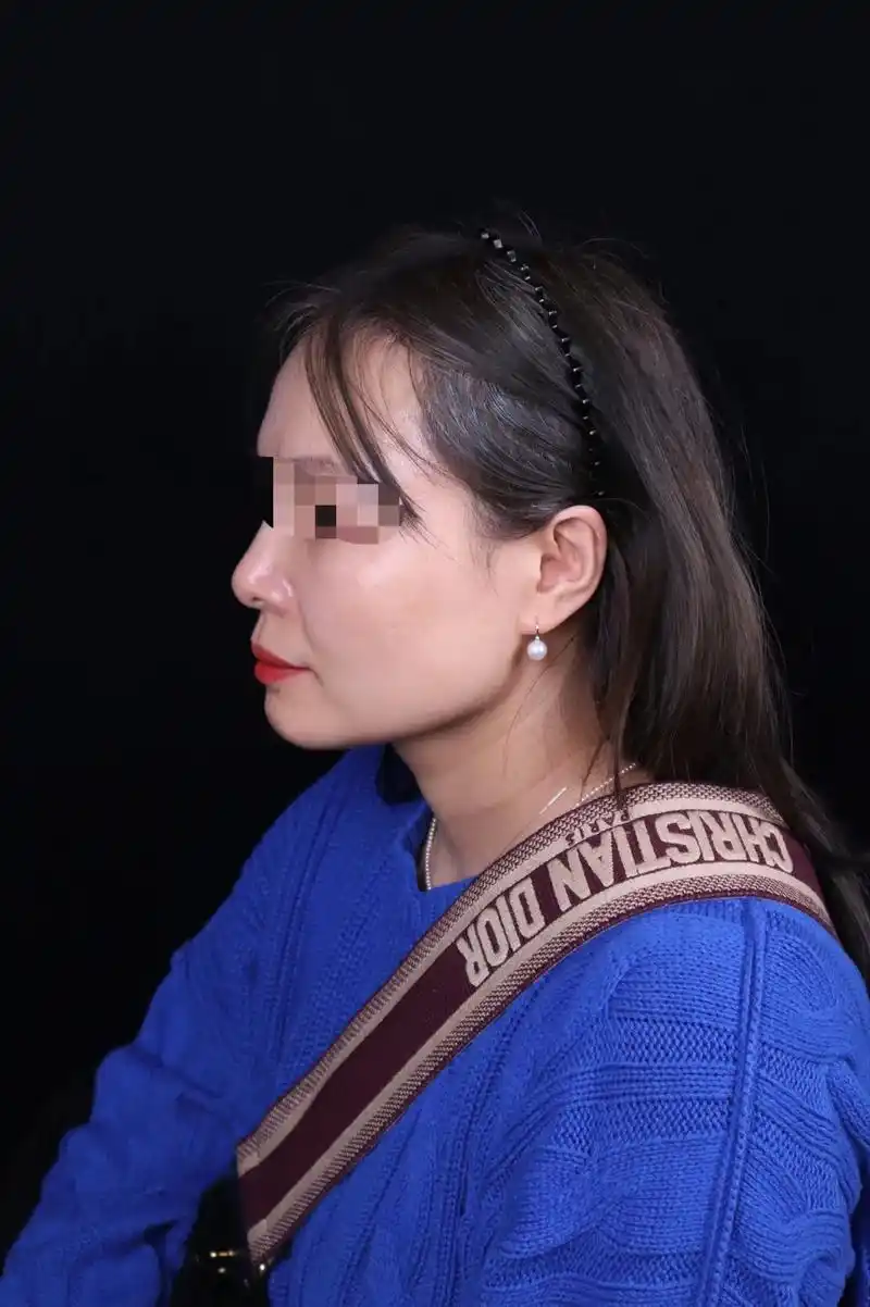 玻尿酸隆鼻,注射4年半,没有变宽也没有明显吸收.现在高分子玻 - 抖音