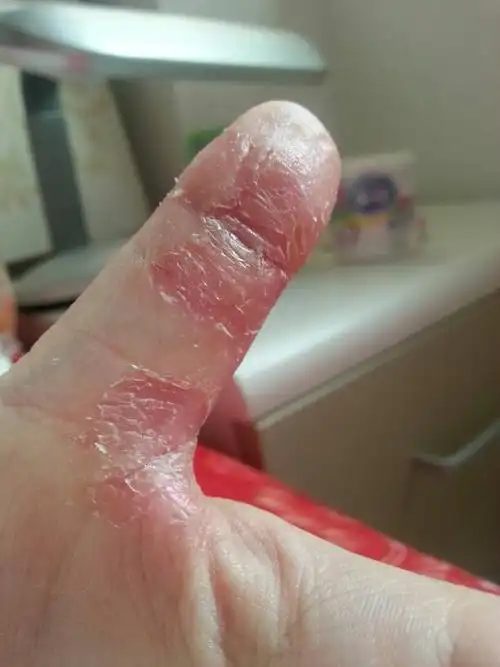 夏秋季节手指脱皮,起先是硬的干瘪的泡,这个泡蜕皮后向周围扩展,干裂