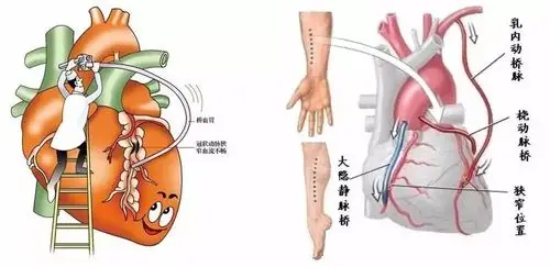通常取一段胸廓内/乳内动脉(ita/ima),前臂-桡动脉(ra),下肢-大隐静脉
