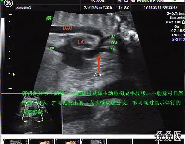 我们一起学习胎儿心脏吧看看这个切面