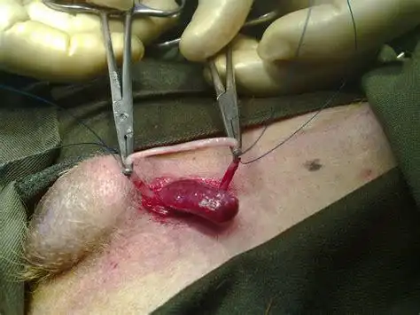 男性结扎 - 搜狗英文