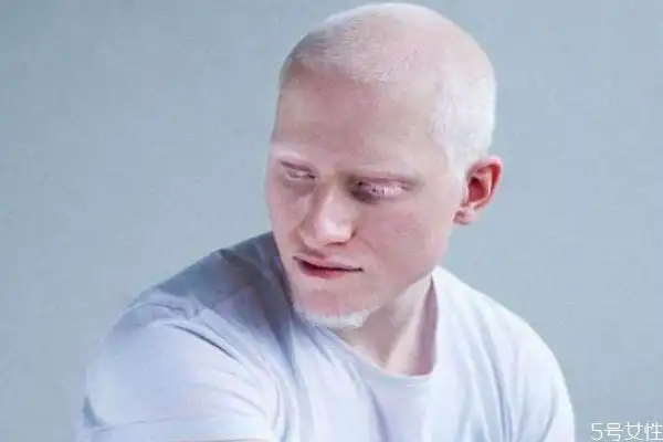 白化病是怎么引起的呢 如果预防白化病呢