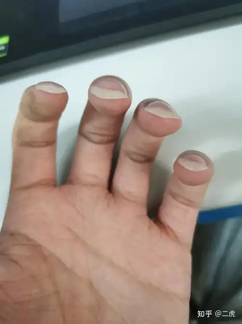 指甲长出的一半向下弯曲是什么情况? - 知乎