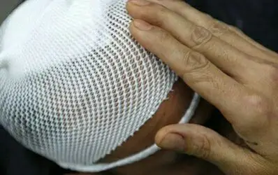 头颅部外伤,有时是这样包扎的.