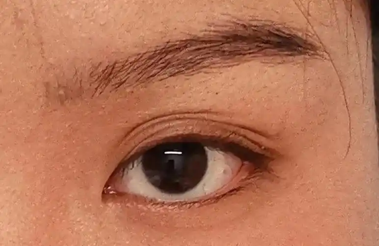 眼皮越来越多层了咋办嘛0101