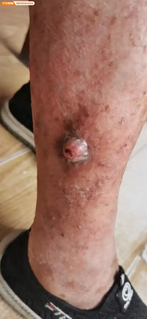 又名表皮癌,棘细胞癌,是一种发生于表皮或附属器细胞的一种恶性肿瘤