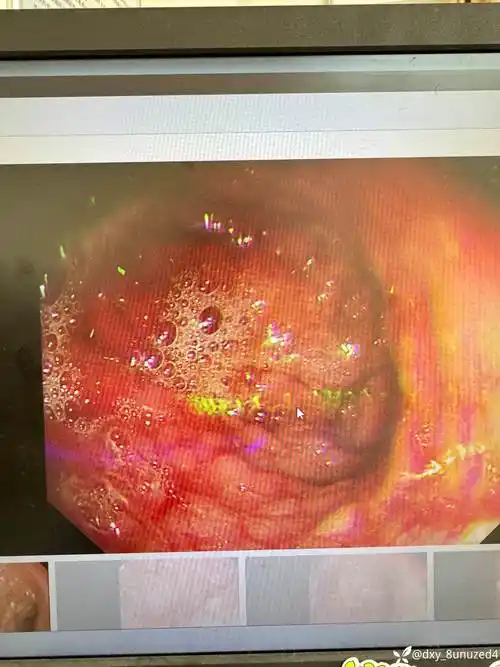 病例分享求大神解析胃多发溃疡多种抑酸药均无效