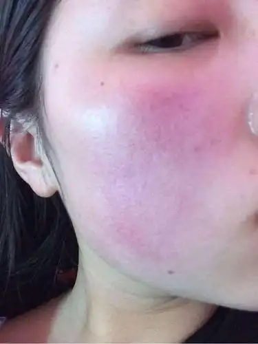 春暖花开时节,造成激素脸反复过敏