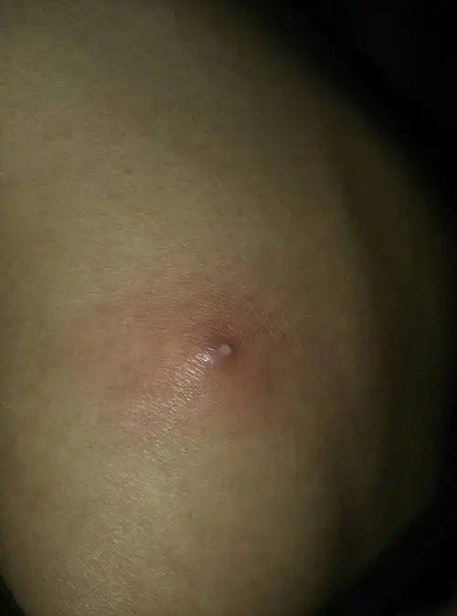 大腿上长了脓包,跟裤子摩擦的时候有点痛