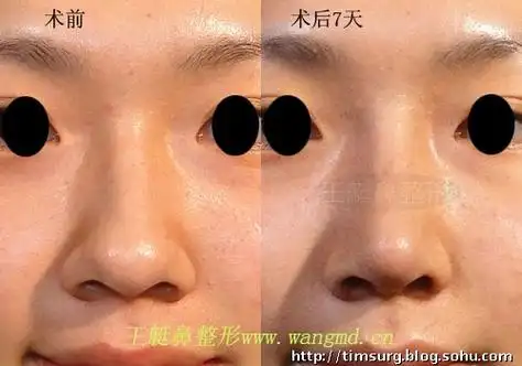 鼻头整形 大鼻头缩小 鼻翼缩小(鼻翼外切),鼻翼基地内收 手术方案:取