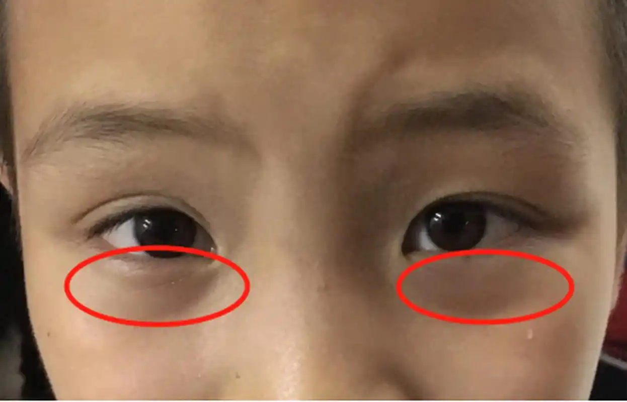 孩子眼窝下眼睑发青,排除睡眠不足的情况,有部分原因是因为孩子的