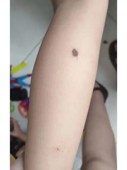 孩子腿上的是痣吗
