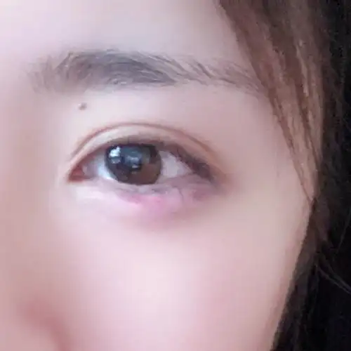 卧蚕直接打紫了…两个眼睛皮下全是瘀血…三天了还很严重… 建议大家