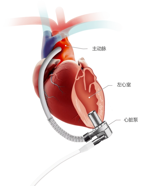 浙大儿院开始向社会招募受试者,可免费植入人工心脏_儿童_心力衰竭