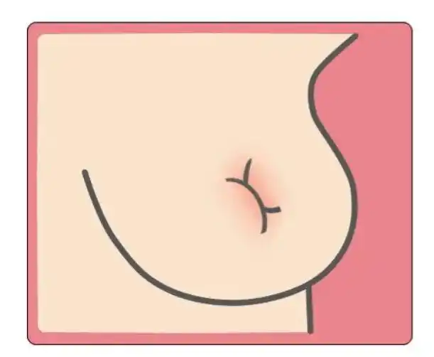 如果有这些症状,警惕乳腺癌找上门_澎湃号·湃客_澎湃新闻-the paper