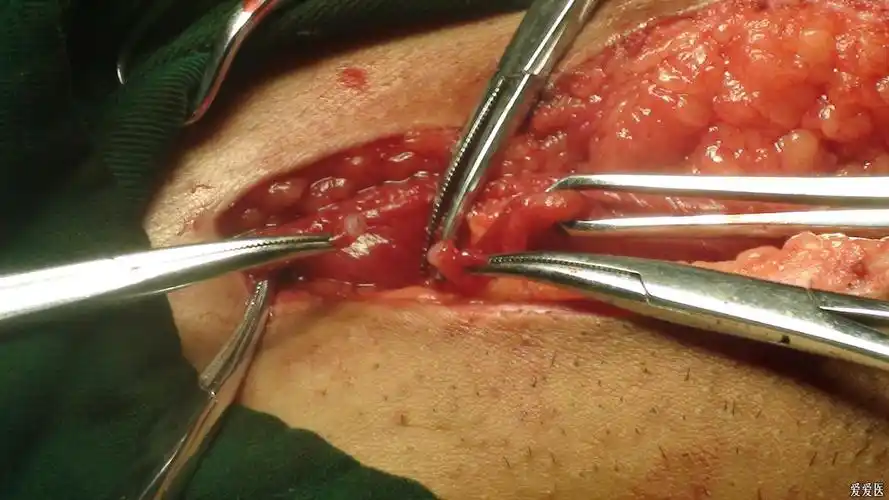 疝气术后损伤输精管