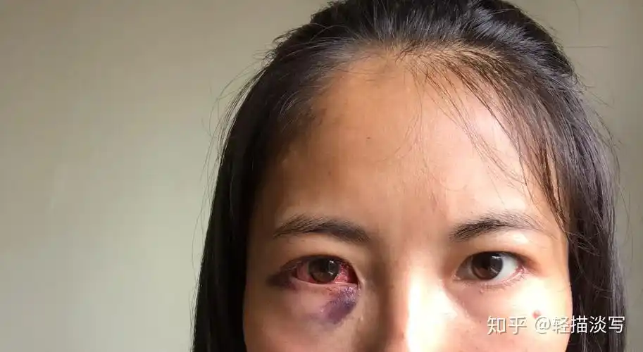 记录斜视手术的一天n