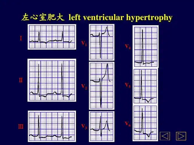 无忧文档 所有分类 医药卫生 医院心电图学ppt 左心室肥大 left