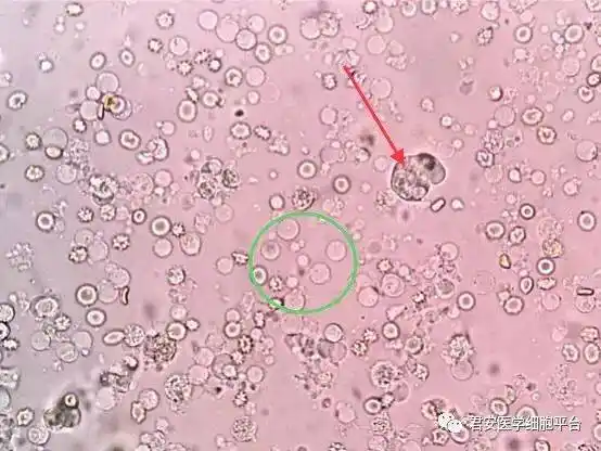 人芽囊原虫病与阿米巴感染的不期而遇