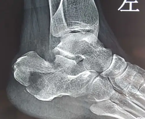 微创撬拨复位空心钉固定治疗跟骨骨折