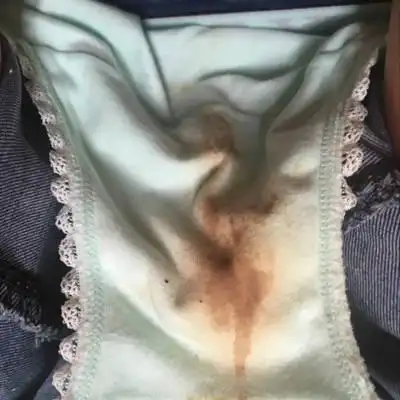 今天早上发现内裤上面发黄还有点血是发炎了吗?