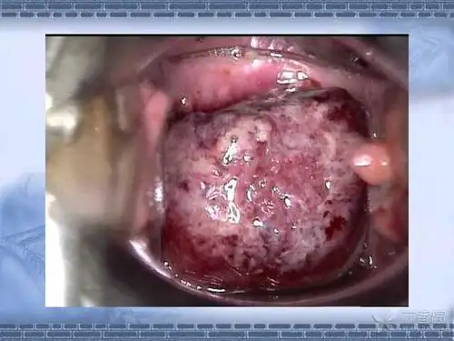 精彩幻灯:宫颈癌36个典型病例宫颈图像详解