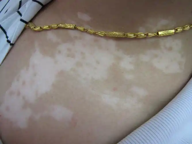 白癜风并发症有哪些