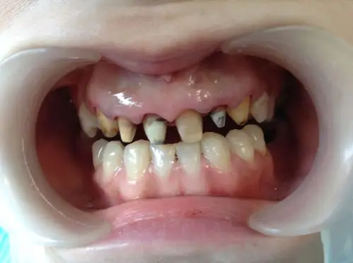 每日案例全瓷牙修复案例