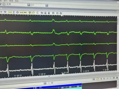 术前心电图,房颤心率,心室率很快