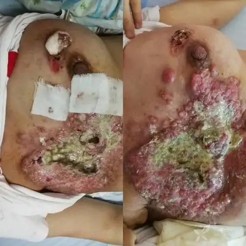 乳腺癌晚期病人,大家来看看有什么好办法? [病例帖]