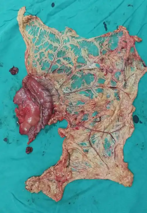 内蒙古民族大学附属医院蒙医外科完成第一例腹腔镜胃癌根治术